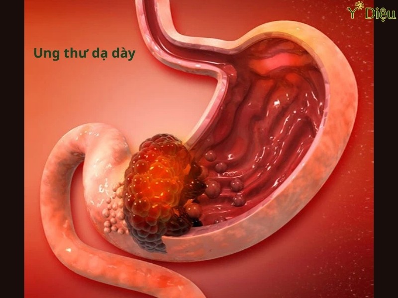 Dấu Hiệu Ung Thư Dạ Dày: Phát Hiện Sớm Để Kiểm Soát Hiệu Quả